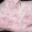7. Dyshidrosis on Hands Pictures