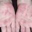 9. Dyshidrosis on Hands Pictures