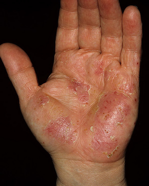 Dyshidrosis on Hands Pictures 54 Photos & Images