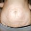 11. Stretch Marks on Stomach Pictures