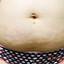 14. Stretch Marks on Stomach Pictures