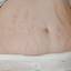 18. Stretch Marks on Stomach Pictures