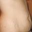 20. Stretch Marks on Stomach Pictures