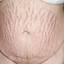21. Stretch Marks on Stomach Pictures