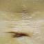 24. Stretch Marks on Stomach Pictures
