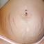 26. Stretch Marks on Stomach Pictures