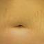 29. Stretch Marks on Stomach Pictures