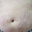 32. Stretch Marks on Stomach Pictures