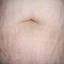 33. Stretch Marks on Stomach Pictures