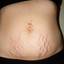 4. Stretch Marks on Stomach Pictures