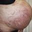 6. Stretch Marks on Stomach Pictures