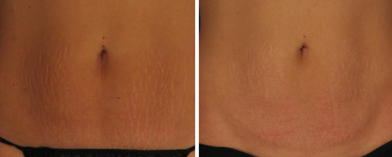 Stretch marks, also known as striae, are scars that appear on various parts...