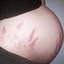 2. Pregnancy Stretch Marks Pictures