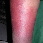 Erysipelas on Leg Symptoms