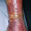 10. Erysipelas on Leg Symptoms Pictures