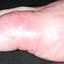13. Erysipelas on Leg Symptoms Pictures