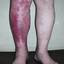 16. Erysipelas on Leg Symptoms Pictures