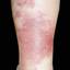 19. Erysipelas on Leg Symptoms Pictures