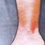 2. Erysipelas on Leg Symptoms Pictures