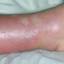 20. Erysipelas on Leg Symptoms Pictures