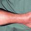 4. Erysipelas on Leg Symptoms Pictures
