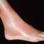 5. Erysipelas on Leg Symptoms Pictures