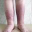 7. Erysipelas on Leg Symptoms Pictures