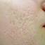 1. Chicken Pox Scars Pictures