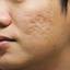 4. Chicken Pox Scars Pictures