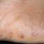 11. Dyshidrosis Pictures