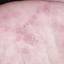 12. Dyshidrosis Pictures