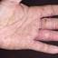 15. Dyshidrosis Pictures