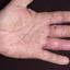 16. Dyshidrosis Pictures