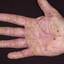 18. Dyshidrosis Pictures