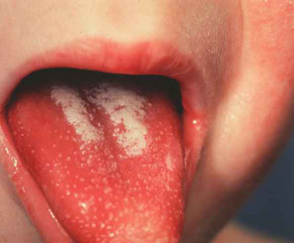 Scarlet Fever Rash Pictures – 23 Photos & Images / illnessee.com