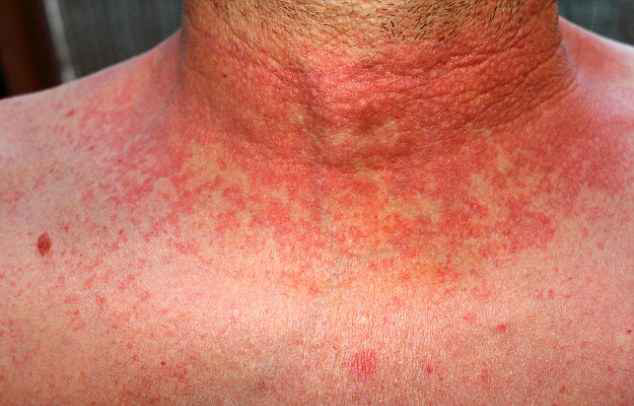 scarlet-fever-rash-pictures-23-photos-images-illnessee