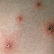 Signs and Symptoms of Chickenpox