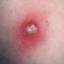 12. Signs and Symptoms of Chickenpox Pictures