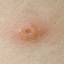 14. Signs and Symptoms of Chickenpox Pictures