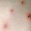 23. Signs and Symptoms of Chickenpox Pictures