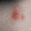 24. Signs and Symptoms of Chickenpox Pictures