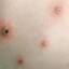 3. Signs and Symptoms of Chickenpox Pictures