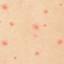 6. Signs and Symptoms of Chickenpox Pictures