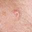 9. Signs and Symptoms of Chickenpox Pictures