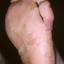 13. Dyshidrosis Foot Pictures