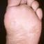 14. Dyshidrosis Foot Pictures