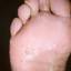 15. Dyshidrosis Foot Pictures