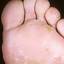 16. Dyshidrosis Foot Pictures