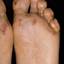 3. Dyshidrosis Foot Pictures
