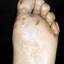 4. Dyshidrosis Foot Pictures